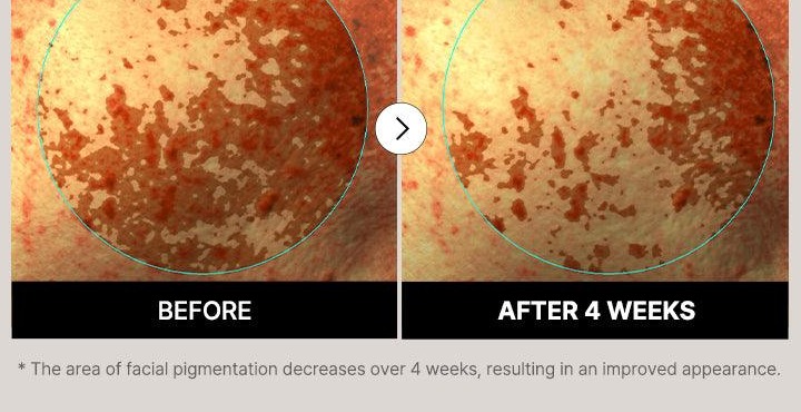 Facial pigmentation imaging before and after four weeks of COSRX The Alpha-Arbutin 2 Discoloration Care Serum